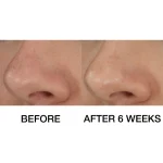 CLINIQUE BLACKHEAD SOLUTIONS 20ML – Image 3